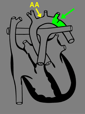 Coarctation