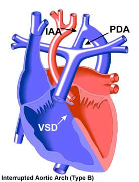 Interrupted Aortic Arch