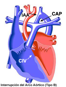 Interrupted Aortic Arch