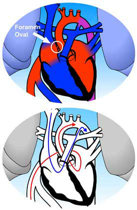 Patent Foramen Ovale